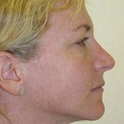 Brow Lift Before & After Patient #428