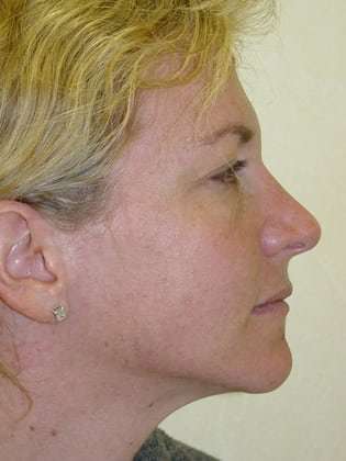 Brow Lift Before & After Patient #428