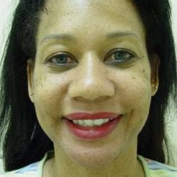Brow Lift Before & After Patient #431