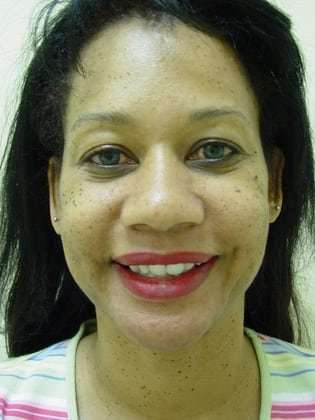 Brow Lift Before & After Patient #431