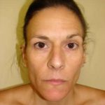 Brow Lift Before & After Patient #437