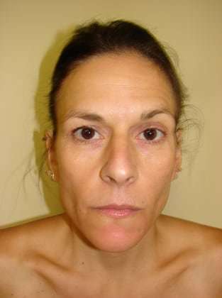 Brow Lift Before & After Patient #437