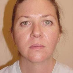 Brow Lift Before & After Patient #440