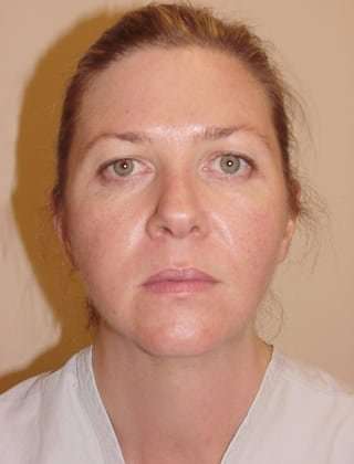 Brow Lift Before & After Patient #440