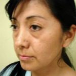 Blepharoplasty Before & After Patient #443