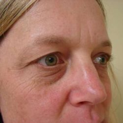 Blepharoplasty Before & After Patient #446