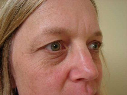 Blepharoplasty Before & After Patient #446