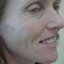 Laser Resurfacing Before & After Patient #152