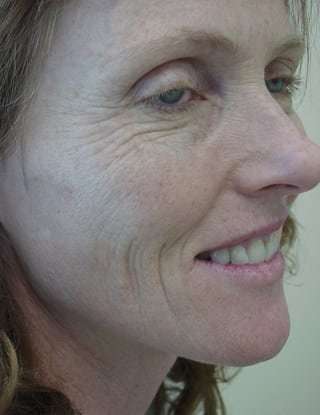 Laser Resurfacing Before & After Patient #152