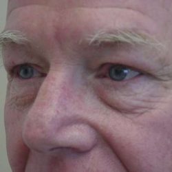 Blepharoplasty Before & After Patient #449