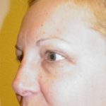 Blepharoplasty Before & After Patient #452