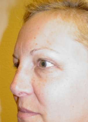 Blepharoplasty Before & After Patient #452