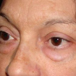Blepharoplasty Before & After Patient #455