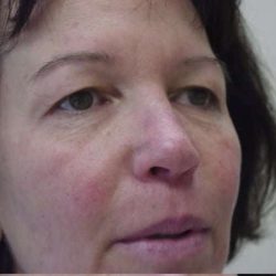 Blepharoplasty Before & After Patient #458