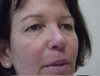 Blepharoplasty Before & After Patient #458