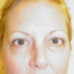 Blepharoplasty Before & After Patient #461