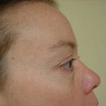 Blepharoplasty Before & After Patient #464