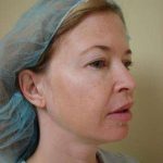 Blepharoplasty Before & After Patient #467