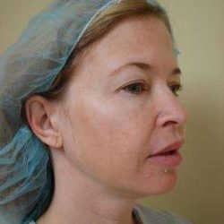 Blepharoplasty Before & After Patient #467