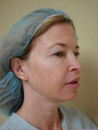 Blepharoplasty Before & After Patient #467