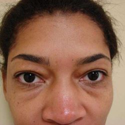 Blepharoplasty Before & After Patient #473