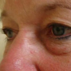 Blepharoplasty Before & After Patient #476