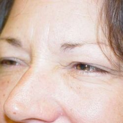 Blepharoplasty Before & After Patient #479