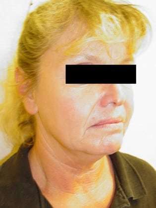 Laser Resurfacing Before & After Patient #121