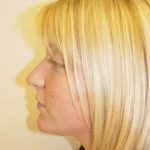 Rhinoplasty Before & After Patient #241
