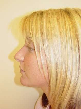 Rhinoplasty Before & After Patient #241