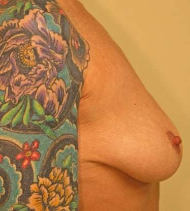 Breast Lift Before & After Patient #555