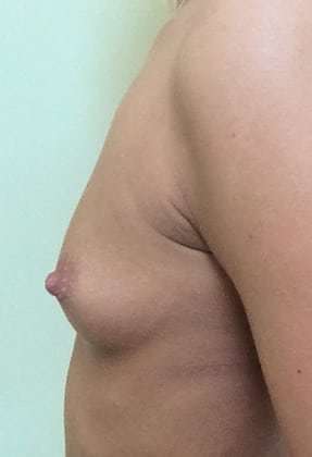 Breast Augmentation Before & After Patient #700