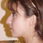 Rhinoplasty Before & After Patient #246