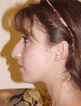 Rhinoplasty Before & After Patient #246