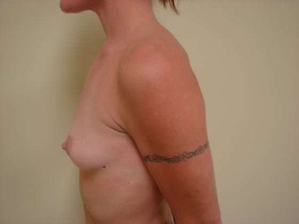 Breast Augmentation Before & After Patient #782