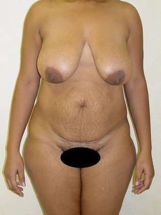Tummy Tuck Before & After Patient #863