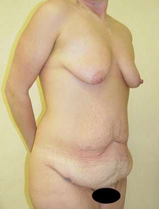 Tummy Tuck Before & After Patient #899