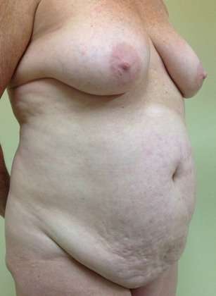 Mommy Makeover Before & After Patient #956