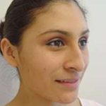 Rhinoplasty Before & After Patient #263