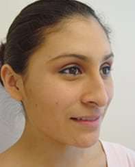 Rhinoplasty Before & After Patient #263