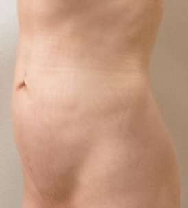 Liposuction Before & After Patient #988