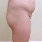 Brazilian Butt Lift Before & After Patient #1019