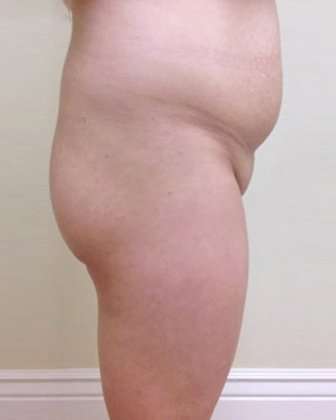 Brazilian Butt Lift Before & After Patient #1019