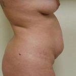 Abdominoplasty Before & After Patient #1093