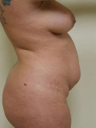 Abdominoplasty Before & After Patient #1093