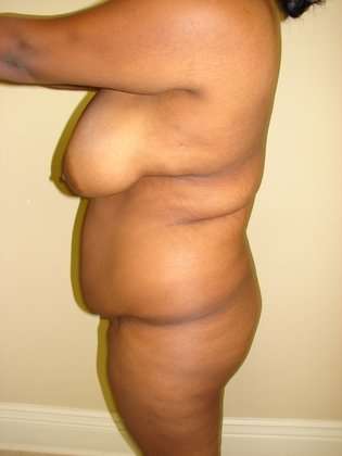 Abdominoplasty Before & After Patient #1098