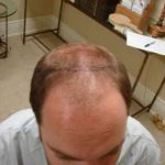 Hair Transplants Before & After Patient #328