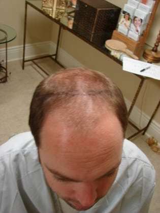 Hair Transplants Before & After Patient #328