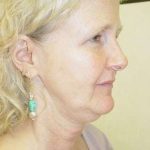 Facelift Before & After Patient #358