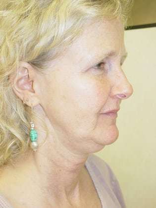 Facelift Before & After Patient #358